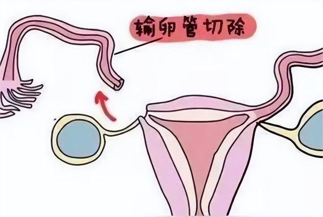 丹东试管婴儿助孕